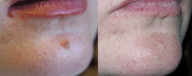 Plastic Surgery Before and After in Toronto